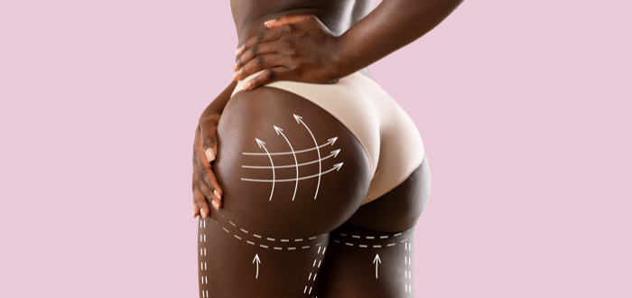 BBL zonder operatie - Inches by Brenda, Helmond, Noord-Brabant