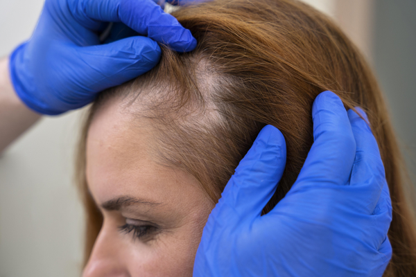 Meso-haartherapie door Inches by Brenda - d&eacute; salon in Helmond, Noord-Brabant